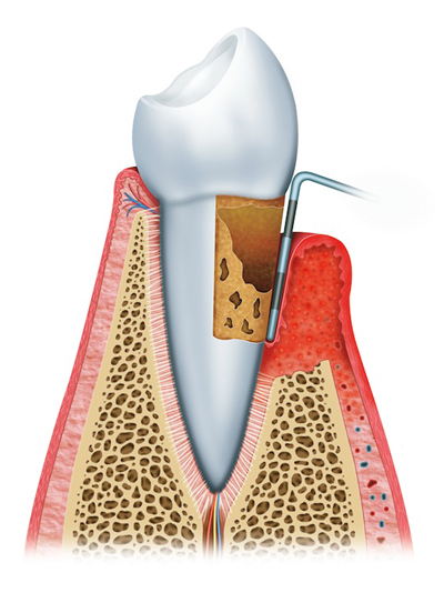 Stages of Gum Disease Irvine, CA