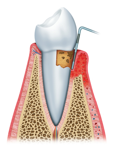 Stages of Gum Disease Irvine, CA