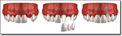 dental implants in Irvine, CA 92618