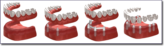 dental implants in Irvine, CA 92618