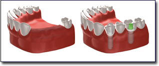 dental implants in Irvine, CA 92618