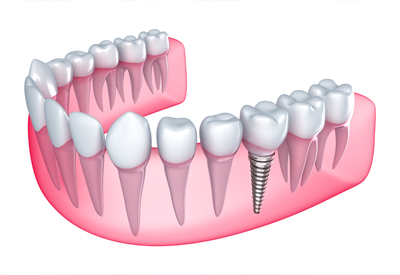 benefits of dental implants in Irvine, CA 92618