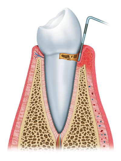 Stages of Gum Disease Irvine, CA
