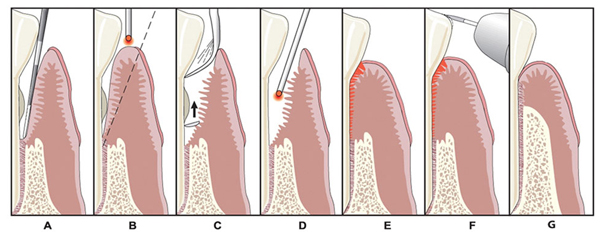 Diagram of gum surgery in Irvine, CA