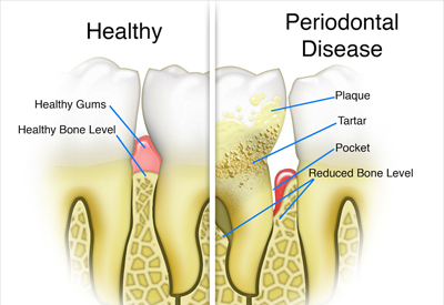 periodontal disease in Irvine, CA 