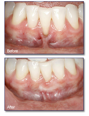 periodontal plastic surgery in Irvine, CA 92618